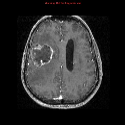 File:Bronchogenic carcinoma brain metastasis (Radiopaedia 9286-9969 Axial T1 C+ 13).jpg