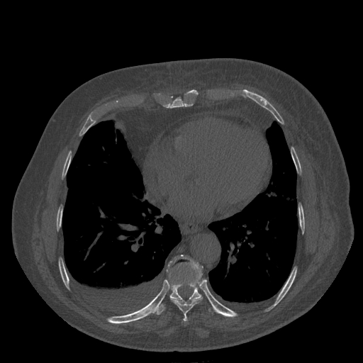 Bronchogenic carcinoma with metastatic lymphadenopathy (Radiopaedia 37671-39569 Axial bone window 37).jpg