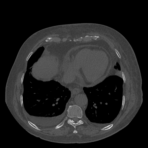 Bronchogenic carcinoma with metastatic lymphadenopathy (Radiopaedia 37671-39569 Axial bone window 41).jpg