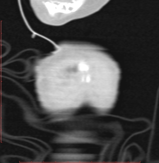 Bronchogenic cyst (Radiopaedia 78599-91409 Coronal lung window 4).jpg