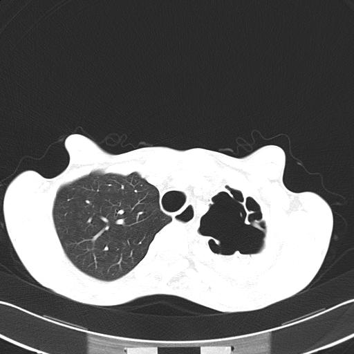 Bronchopleural fistula secondary to tuberculosis (Radiopaedia 20415-20322 Axial lung window 15).jpg