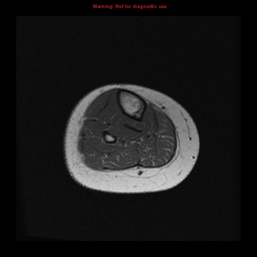 File:Brown tumor (Radiopaedia 12318-12597 Axial T1 30).jpg
