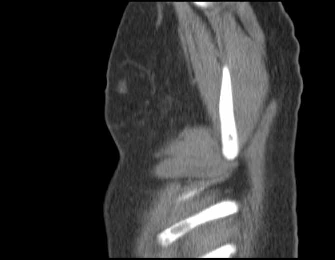 Brown tumors compressing the spinal cord (Radiopaedia 68442-77988 B 56).jpg
