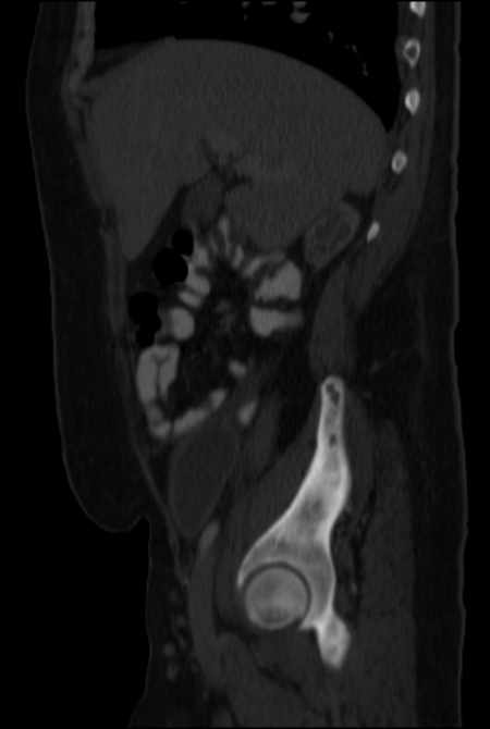 Brown tumors compressing the spinal cord (Radiopaedia 68442-77988 H 18).jpg