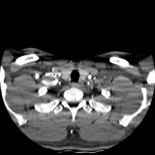 Buccal fat pad arteriovenous malformation (Radiopaedia 70936-81144 D 48).jpg