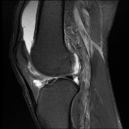 File:Bucket handle tear - medial meniscus (Radiopaedia 69245-79026 Sagittal PD fat sat 7).jpg