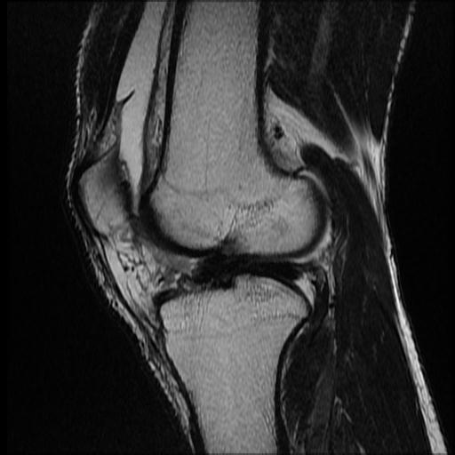 File:Bucket handle tear - medial meniscus (Radiopaedia 69245-79026 Sagittal T2 6).jpg