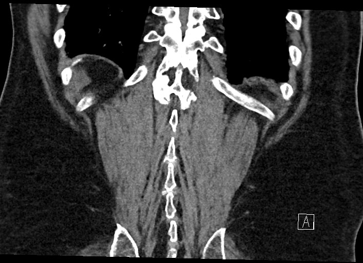 Buried bumper syndrome - gastrostomy tube (Radiopaedia 63843-72577 Coronal Inject 122).jpg