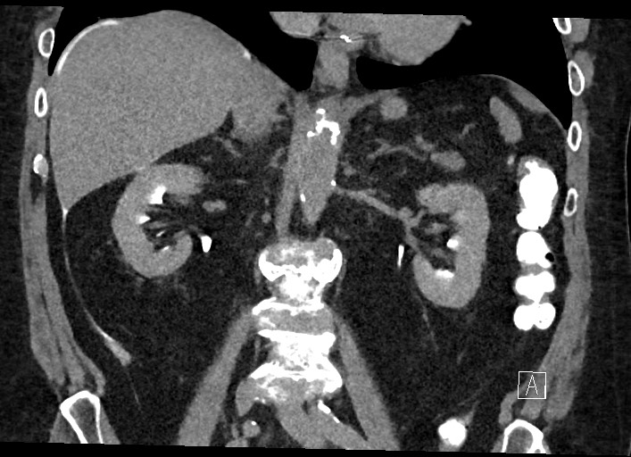 Buried bumper syndrome - gastrostomy tube (Radiopaedia 63843-72577 Coronal Inject 78).jpg