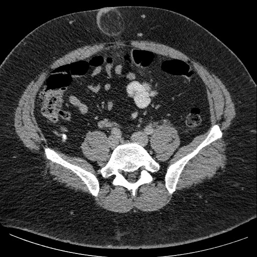 Burned-out testicular seminoma - retroperitoneal nodal metastases (Radiopaedia 62872-71245 A 51).jpg