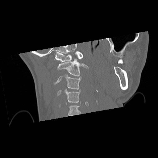 C1-C2 "subluxation" - normal cervical anatomy at maximum head rotation (Radiopaedia 42483-45607 Coronal non-contrast 15).jpg