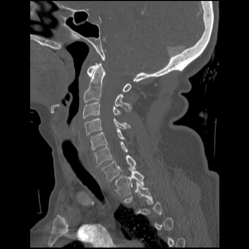 File:C1 anterior arch (plough) fracture - type 1 (Radiopaedia 76181-87720 Sagittal bone window 62).jpg