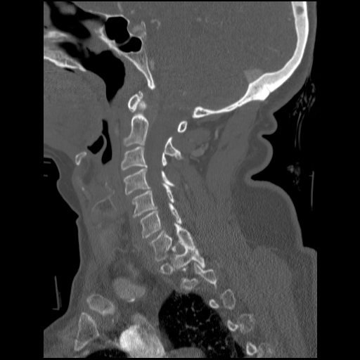 File:C1 anterior arch (plough) fracture - type 1 (Radiopaedia 76181-87720 Sagittal bone window 65).jpg
