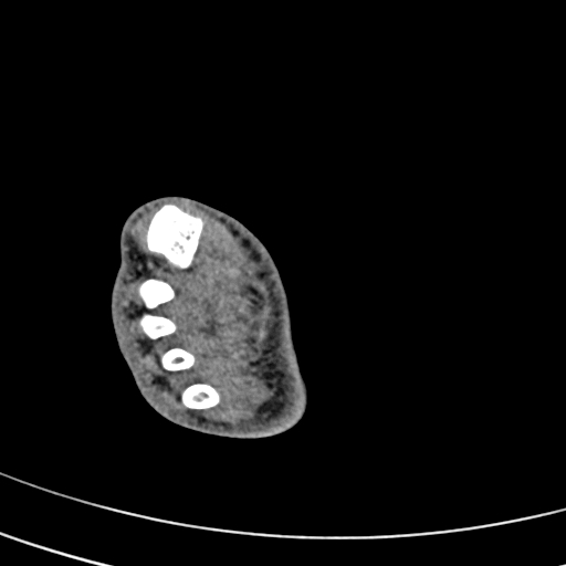 File:Calcaneal fracture - Sanders type 4 (Radiopaedia 90179-107370 Axial non-contrast 39).jpg