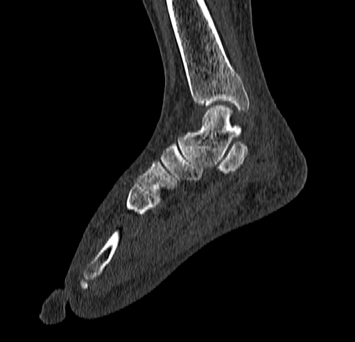 Calcaneal fracture - Sanders type 4 (Radiopaedia 90179-107370 Sagittal bone window 41).jpg