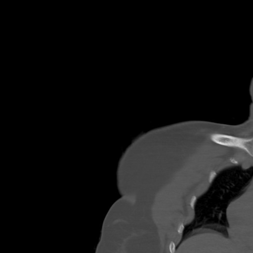 File:Calcific tendinitis of the infraspinatus tendon (Radiopaedia 87256-103539 Coronal bone window 2).jpg