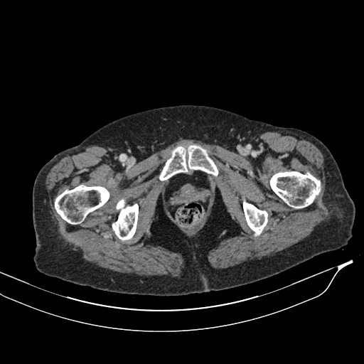 Calcified adrenal glands and Spigelian hernia (Radiopaedia 49741-54988 A 249).jpg