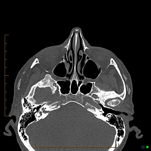 Calcified facial augmentation fillers (Radiopaedia 79514-92679 Axial bone window 4).jpg