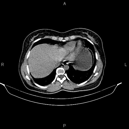 File:Calcified hepatic hydatid cyst (Radiopaedia 84672-100095 Axial non-contrast 15).jpg
