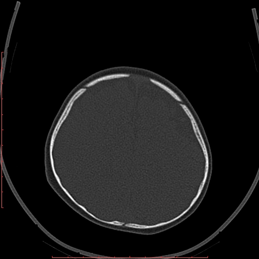 Calcified middle cerebral artery embolism (Radiopaedia 78949-91860 Axial bone window 58).jpg