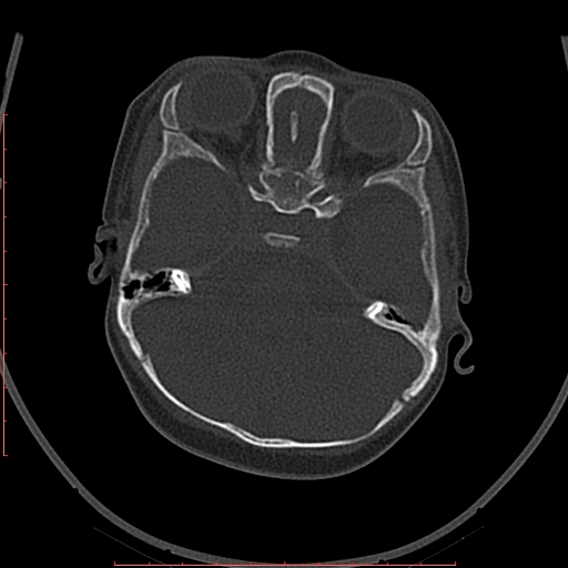 Calcified middle cerebral artery embolism (Radiopaedia 78949-91860 Axial bone window 9).jpg
