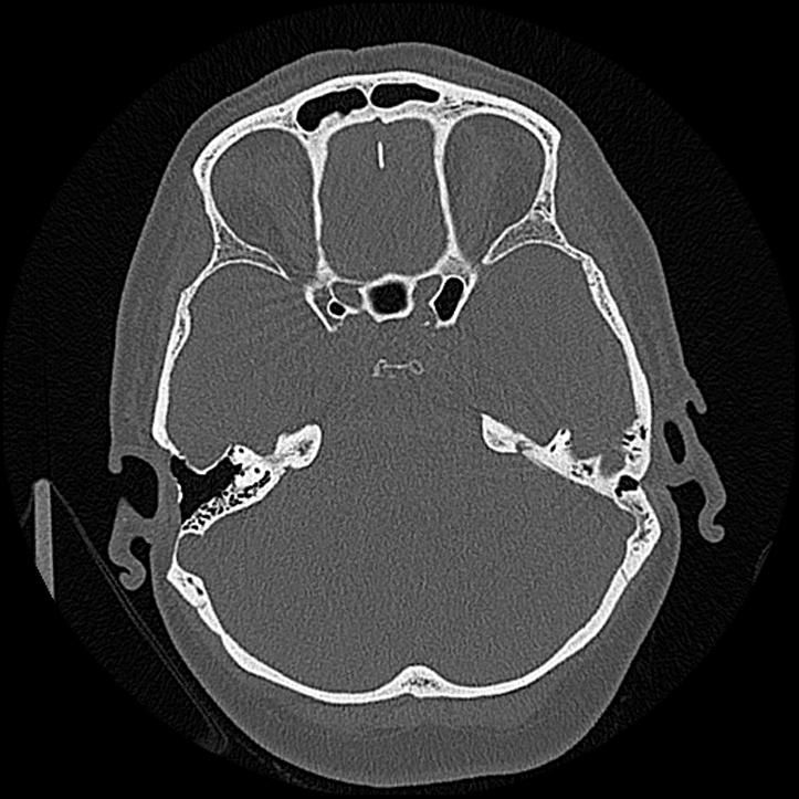 Canal up mastoidectomy (Radiopaedia 78108-90638 Axial bone window 101).jpg