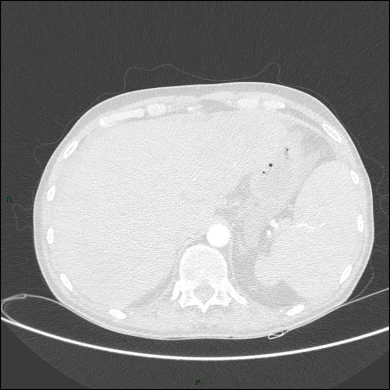 Cannonball metastases (Radiopaedia 82110-96150 Axial lung window 186).jpg