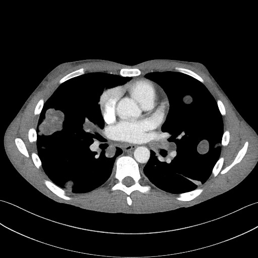 Cannonball metastases - testicular choriocarcinoma (Radiopaedia 84510-99891 B 63).jpg
