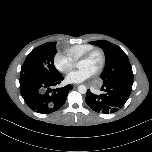 Cannonball metastases - testicular choriocarcinoma (Radiopaedia 84510-99891 B 71).jpg