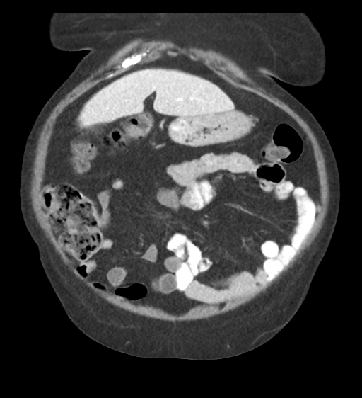 Cannonball metastases from endometrial cancer (Radiopaedia 42003-45031 F 18).png