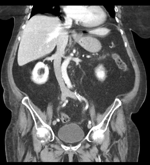 Cannonball metastases from endometrial cancer (Radiopaedia 42003-45031 F 37).png