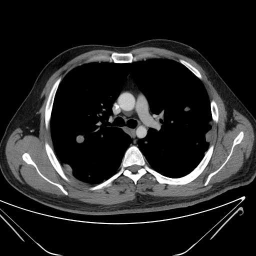 File:Cannonball pulmonary metastases (Radiopaedia 67684-77101 D 111).jpg