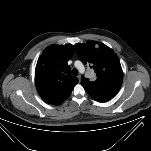 File:Cannonball pulmonary metastases (Radiopaedia 67684-77101 D 83).jpg