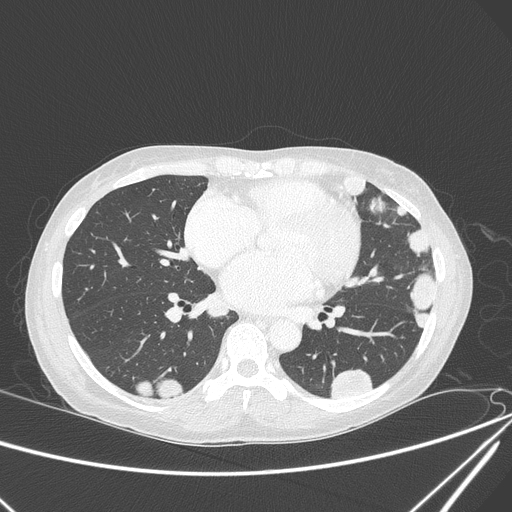 Canonball lung metastasis (Radiopaedia 77634-89837 Axial lung window 106).jpg