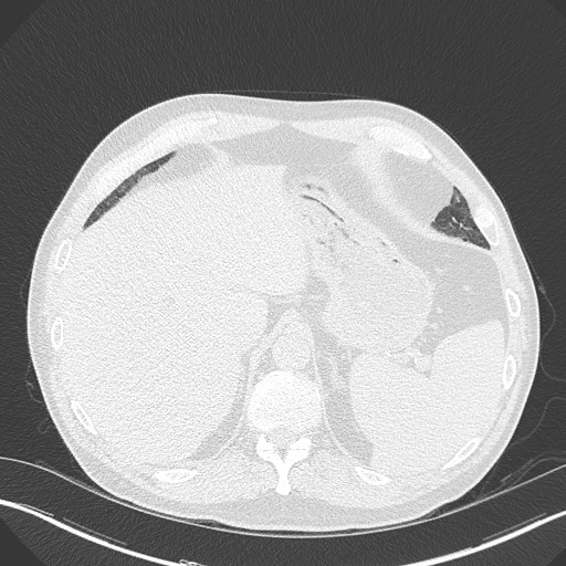Caplan syndrome (Radiopaedia 56667-63530 Axial lung window 173).jpg