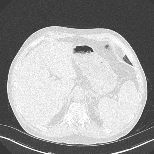 Caplan syndrome (Radiopaedia 56667-63530 Axial lung window 181).jpg