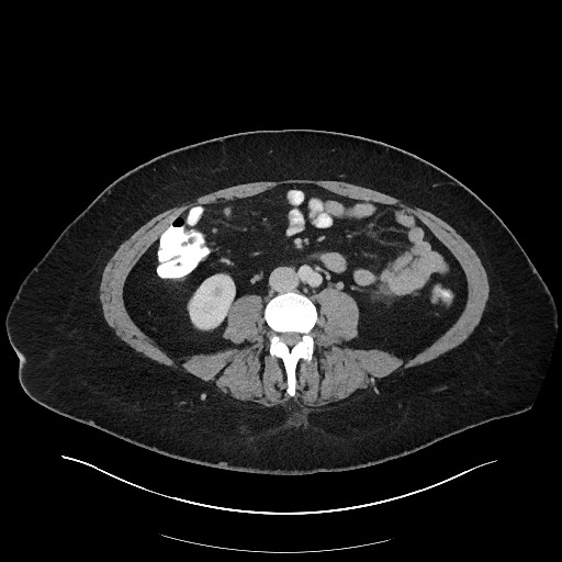 Carcinoid tumor - terminal ileum (Radiopaedia 60931-68739 A 75).jpg