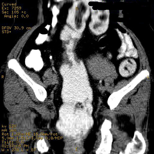 File:Carcinoma of sigmoid colon (Radiopaedia 23071-23100 D 1).jpg