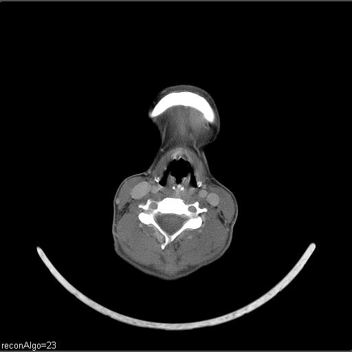 File:Carcinoma of the maxillary antrum (Radiopaedia 53805-59888 Axial C+ delayed 21).jpg