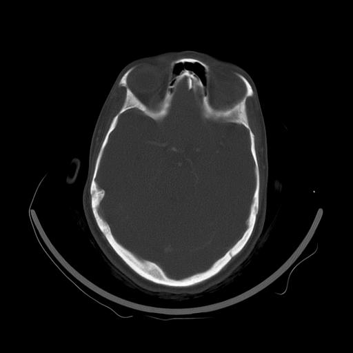 Carcinoma of the maxillary antrum (Radiopaedia 53805-59888 Axial bone window 10).jpg