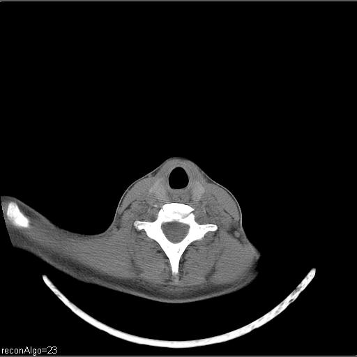 File:Carcinoma of the maxillary antrum (Radiopaedia 53805-59888 Axial non-contrast 19).jpg