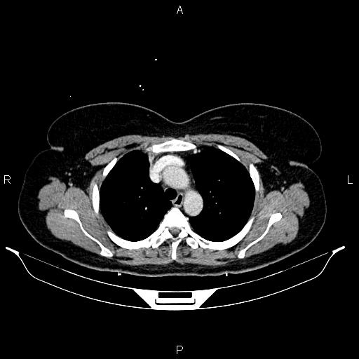 Carcinoma of uterine cervix (Radiopaedia 85861-101700 A 13).jpg
