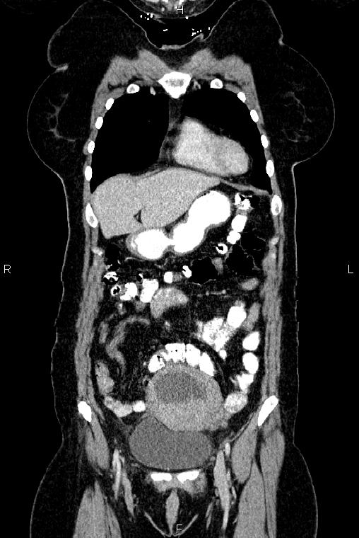 Carcinoma of uterine cervix (Radiopaedia 85861-101700 C 10).jpg