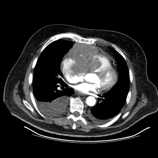 File:Cardiac lymphoma (Radiopaedia 38690-40836 Axial C+ CTPA 11).jpg