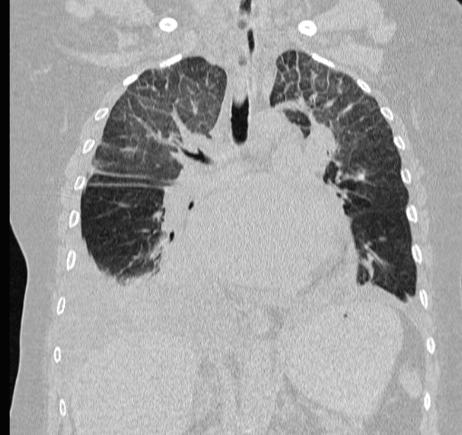 Cardiogenic pulmonary edema (Radiopaedia 29213-29609 Coronal lung window 35).jpg