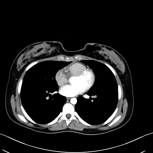 Caroli disease with medullary sponge kidney (Radiopaedia 82622-96804 C 1).jpg