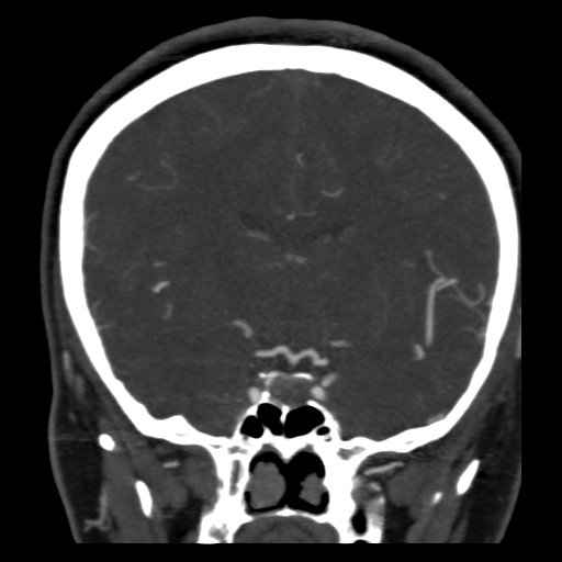 File:Carotico ophthalmic aneurysm (Radiopaedia 42916-46148 B 7).png