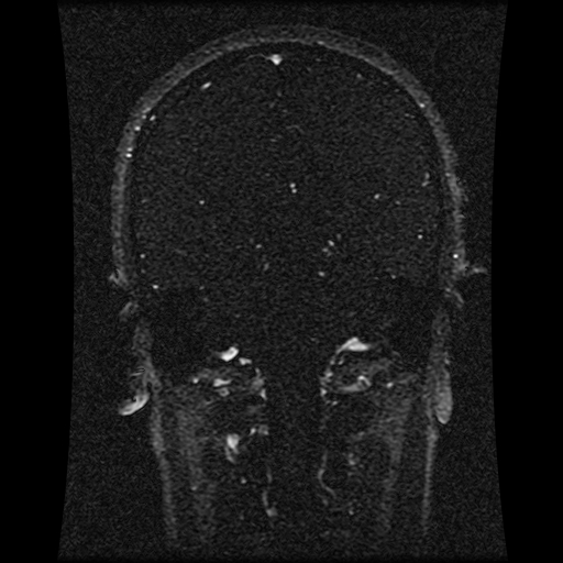 Carotid arterial dissection with acute cerebral infarction (Radiopaedia 26636-26784 MRV 85).jpg