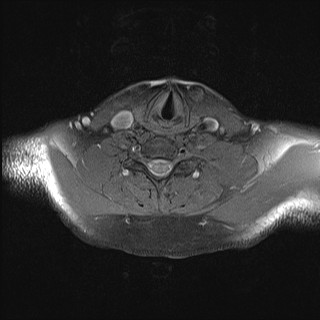 File:Carotid artery dissection (Radiopaedia 28441-28689 Axial T1 fat sat 13).jpg