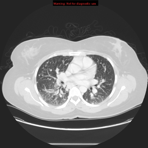 Carotid body tumor with lung metastases (Radiopaedia 9301-48390 Axial lung window 36).jpg